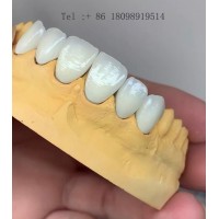 深圳MYY 假牙出口德國專線，假牙出口歐洲 套筒冠